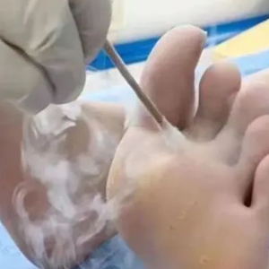 Cryotherapy with Liquid Nitrogen: How Does It Benefit the Medical Field?